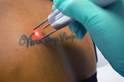 Tattoo Removal - Image 1