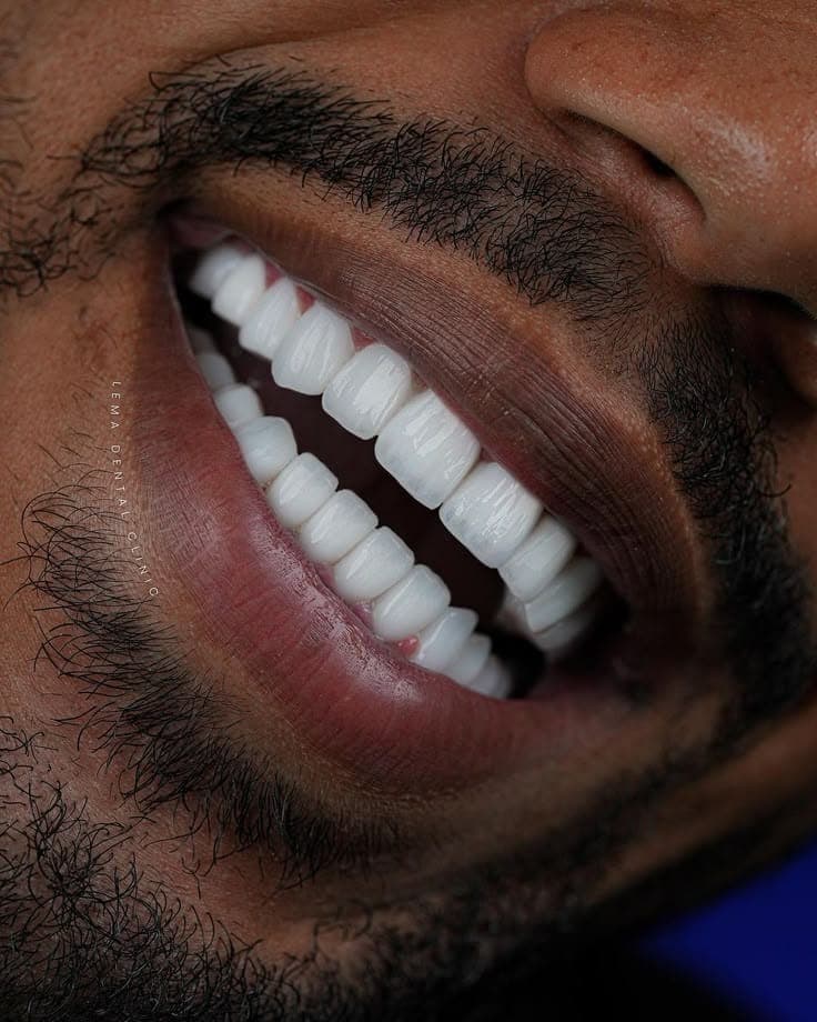 Teeth Whitening - Image 1